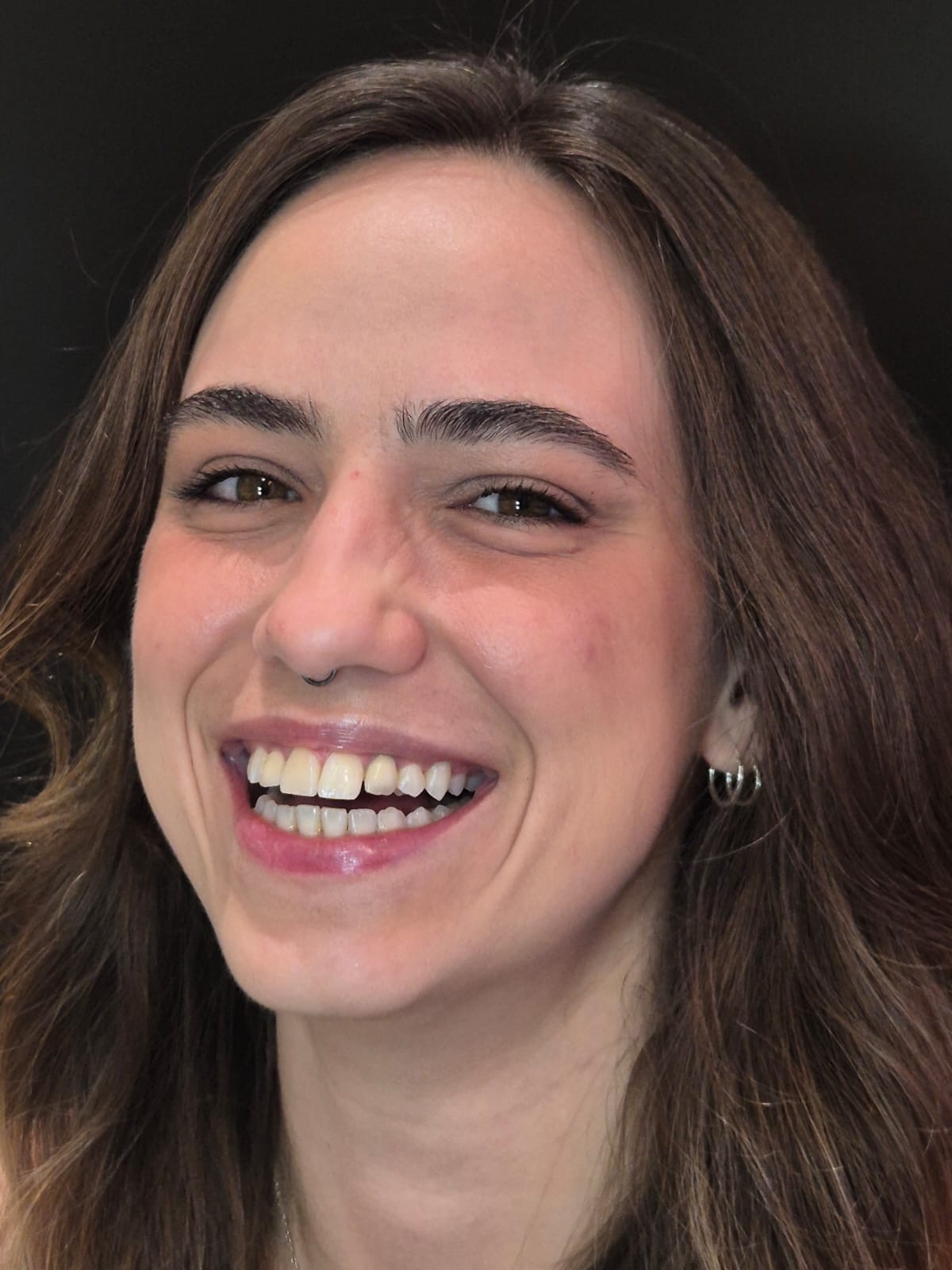 Paciente sorrindo com naturalidade após o tratamento